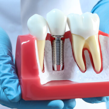 Why Is My Dental Implant Throbbing? 6 Possible Reasons