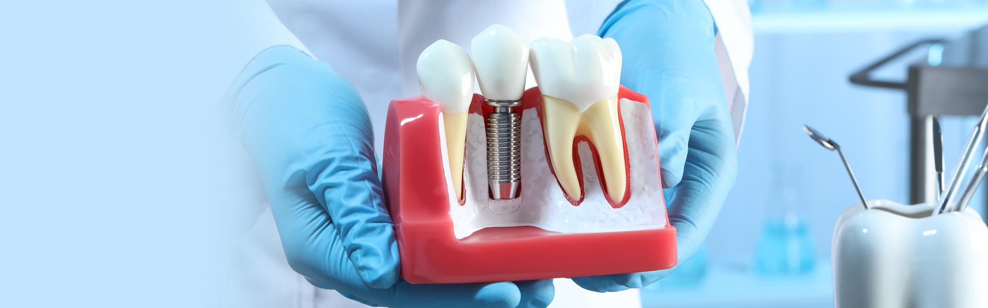 Look And Feel like Your Own Teeth with All on 4 Dental Implants